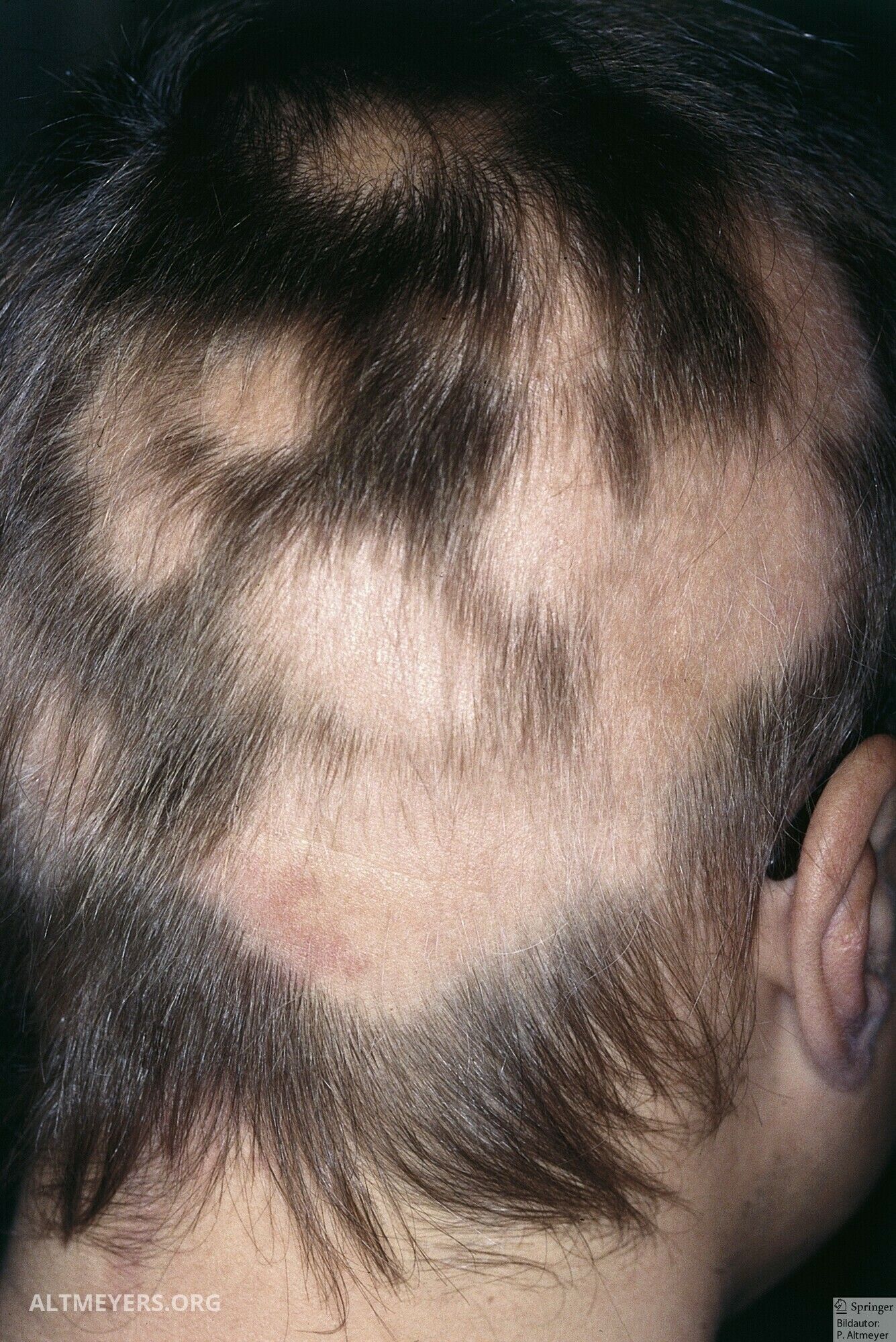 Haarausfall Alopezie Behandlung Hautarzt Frankfurt