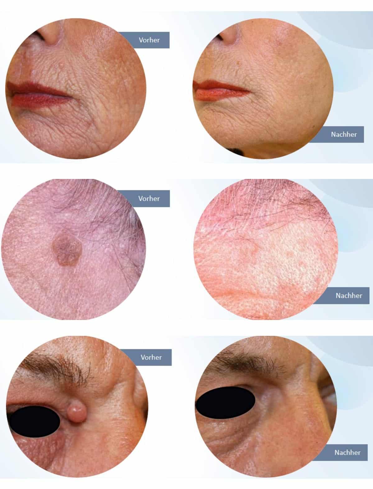 Hautarzt Frankfurt Lasermedizin