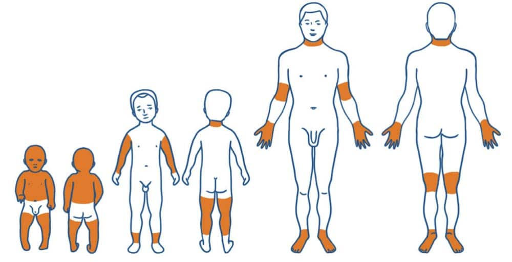 Neurodermitis Hautarztpraxis Frankfurt